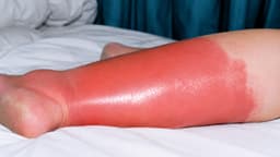 Điều trị và phòng ngừa viêm mô tế bào thế nào?