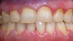 Viêm nha chu: Triệu chứng, điều trị và phòng ngừa
