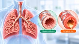 Dấu hiệu, nguyên nhân và cách điều trị viêm phế quản cấp