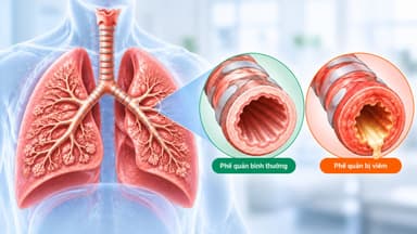 Dấu hiệu, nguyên nhân và cách điều trị viêm phế quản cấp