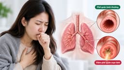 Viêm phế quản mạn: Nguyên nhân, triệu chứng và cách điều trị