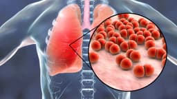 Viêm phổi: Nguyên nhân gây viêm phổi và cách chẩn đoán