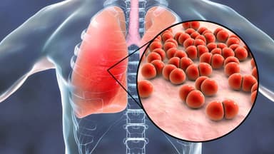 Viêm phổi: Nguyên nhân gây viêm phổi và cách chẩn đoán