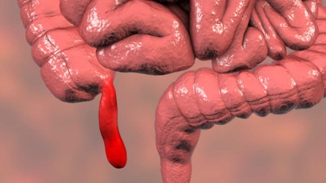 Viêm phúc mạc ruột thừa nguy hiểm thế nào? Dấu hiệu cần nhận biết sớm