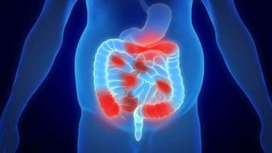 Biến chứng viêm phúc mạc là gì?