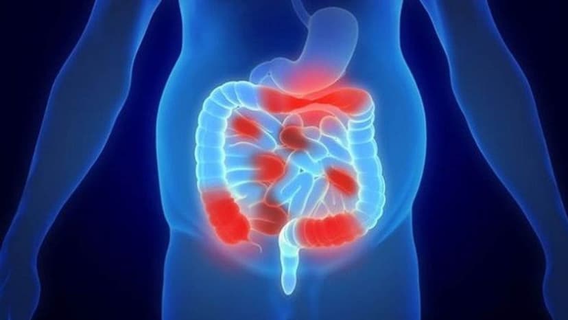 Biến chứng viêm phúc mạc là gì?