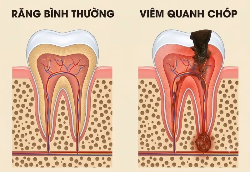 viêm quanh chóp răng