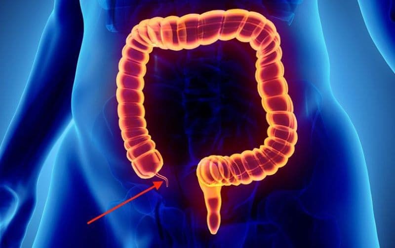 Viêm ruột thừa cấp là tình trạng ruột thừa bị viêm, thường liên quan đến sự tắc nghẽn lòng ruột thừa.