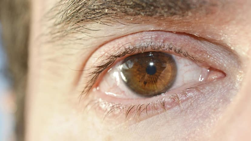 Viêm thần kinh thị giác: Triệu chứng, nguyên nhân và điều trị