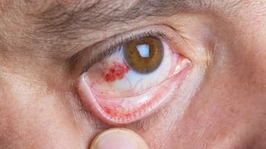 Viêm thượng củng mạc là gì? Nguyên nhân và cách điều trị