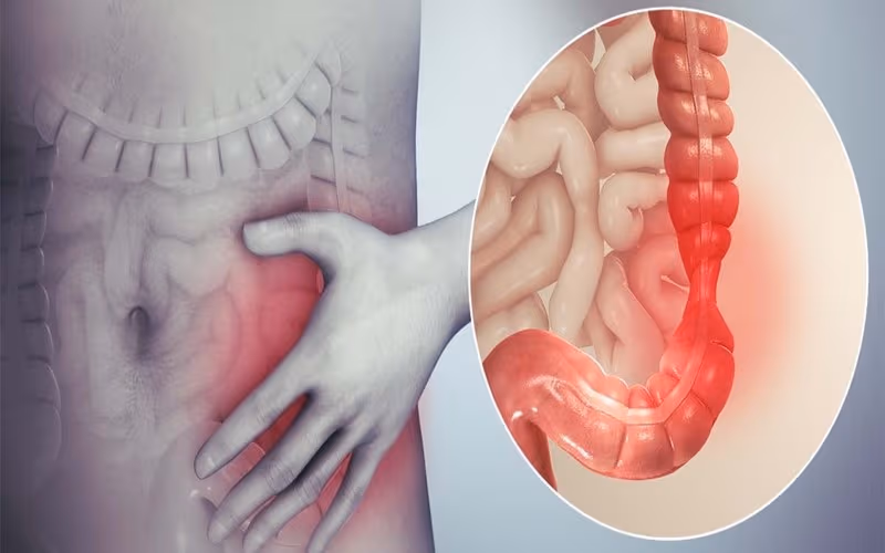 Viêm trực tràng do tia xạ là tình trạng niêm mạc trực tràng bị tổn thương và viêm sau khi người bệnh xạ trị ung thư ở vùng chậu