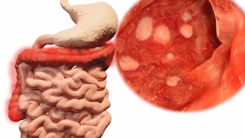 Viêm trực tràng loét có triệu chứng gì? Nguyên nhân do đâu và điều trị như thế nào?