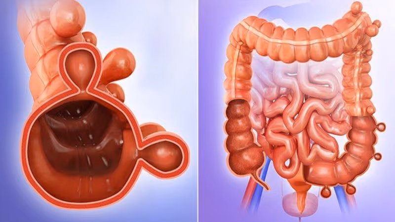 Viêm túi thừa đại tràng là tình trạng một hoặc nhiều túi thừa hình thành trên thành đại tràng bị viêm, đôi khi kèm nhiễm trùng