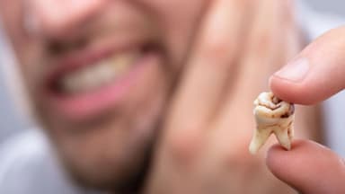 Viêm tủy răng là gì? Nguyên nhân, triệu chứng và cách điều trị