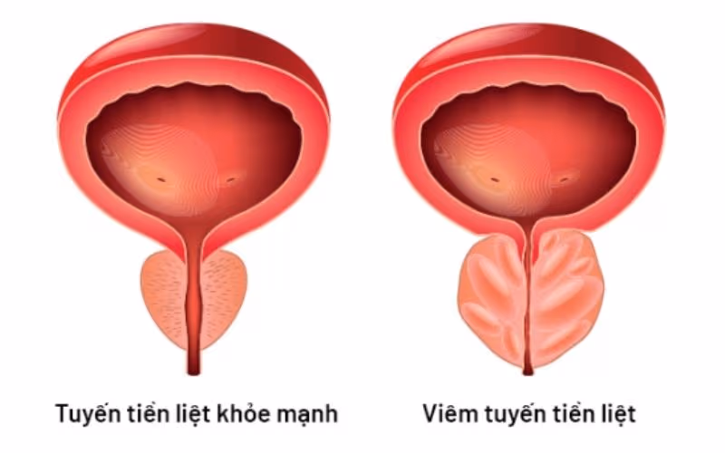 Viêm tuyến tiền liệt là gì?