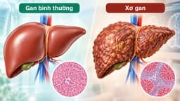 Xơ gan: Nguyên nhân, dấu hiệu, biến chứng và điều trị