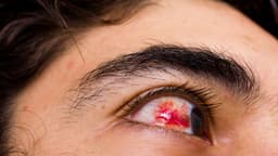 Xuất huyết dịch kính là gì? Dấu hiệu, nguyên nhân và cách điều trị