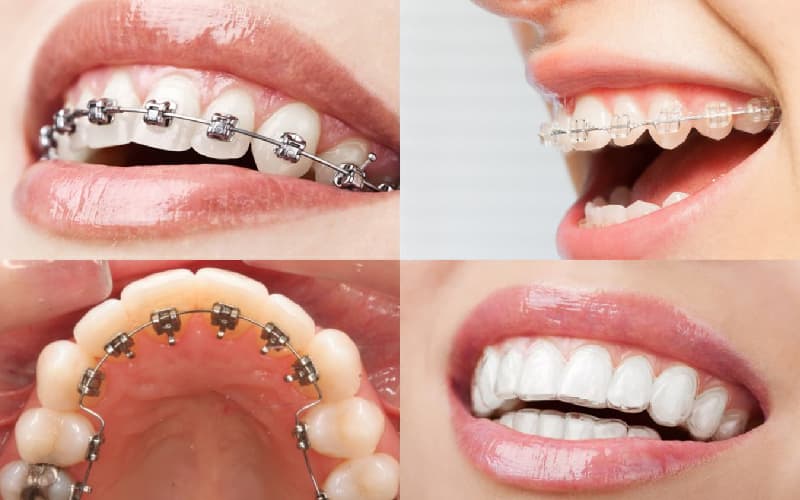 Niềng răng có tốt không tại Bệnh viện