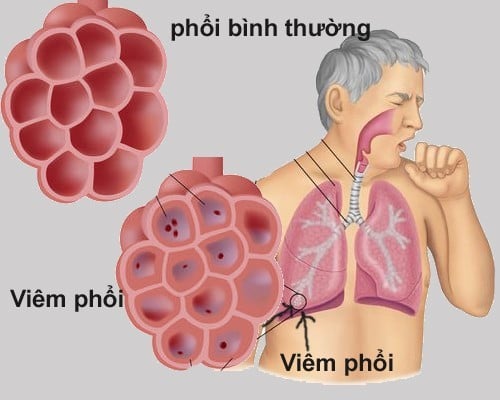 Viêm phổi cấp có lây không ở bệnh viện