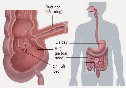 Bệnh Crohn là gì? &#8211; TCI Hospital