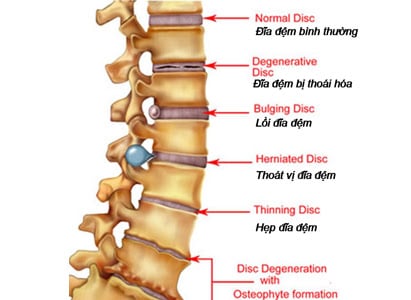 Người bị thoát vị đĩa đệm nên uống thuốc gì?