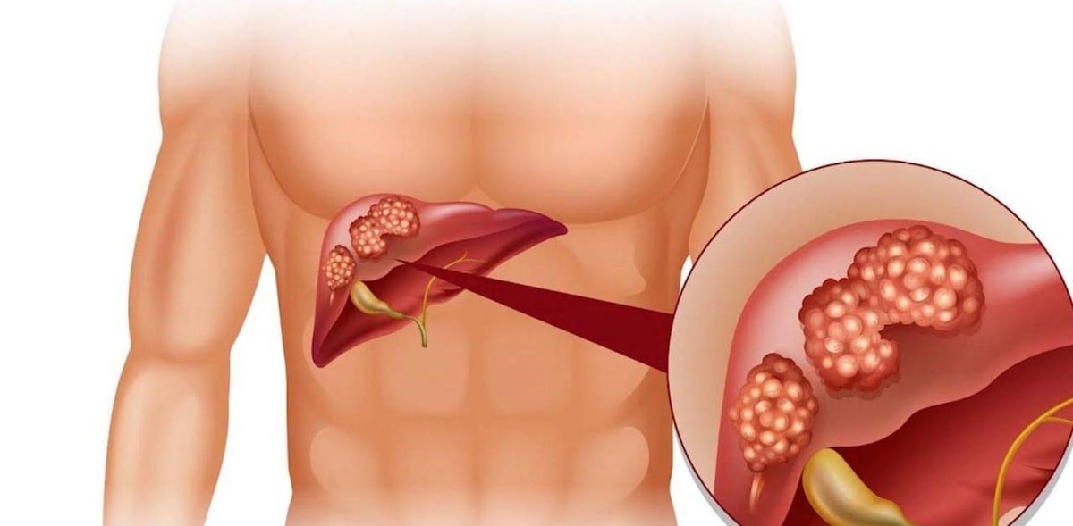 Suy nhược chức năng gan hưởng đến quá trình giải độc