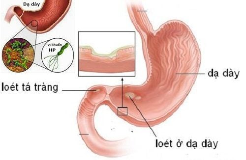 Viêm loét dạ dày tá tràng &#8211; những điều cần biết