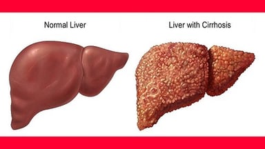Đặc điểm của xơ gan Xơ gan giai đoạn 1