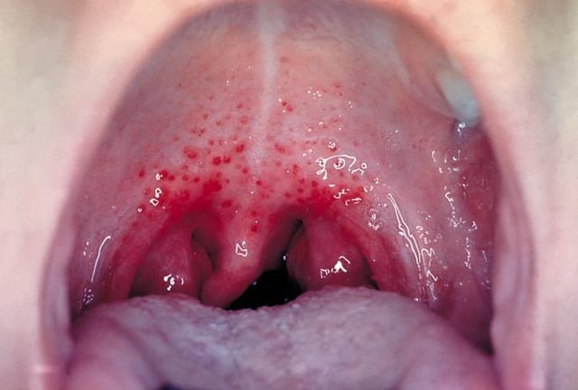 Tìm hiểu về viêm amidan ở trẻ