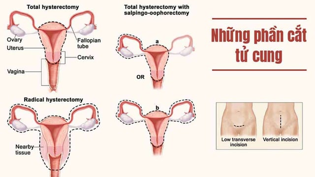 Cắt tử cung bán phần như thế nào?