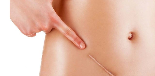 Mổ ruột thừa bằng phương pháp nội soi