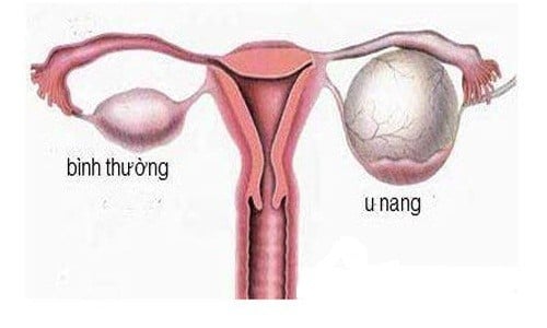 Phẫu thuật u nang buồng trứng cần phải hỗ trợ điều trị