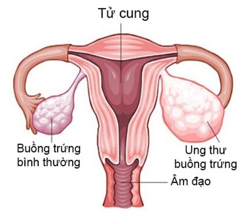 Siêu âm buồng trứng có phát hiện được ung thư không?