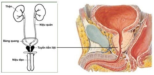 Cách xử trí u xơ tuyến tiền liệt