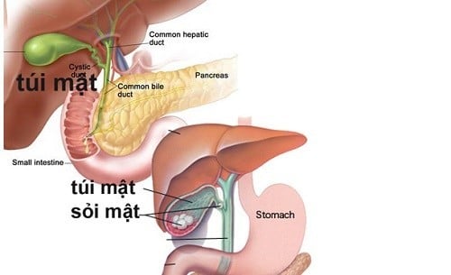 Lưu ý sau cắt túi mật Một vài lưu ý sau cắt túi mật