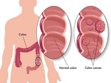 Mổ polyp dạ dày  mang lại hiệu quả cao