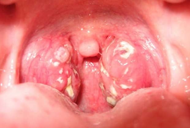 Cần cắt amidan khi nào?bệnh lý thường găp ở trẻ em
