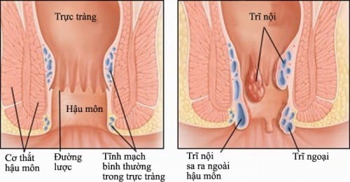 Phân biệt các dạng bệnh trĩ