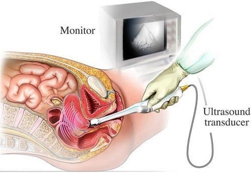 Siêu âm đầu dò là gì? cần thiết để thăm khám