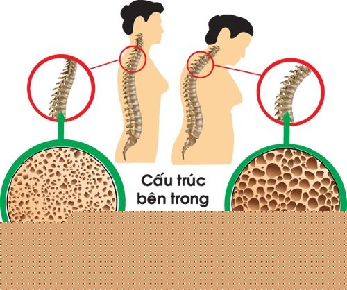 Đo loãng xương như thế nào?