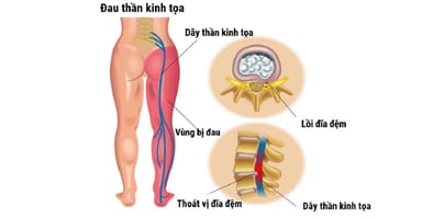 Những điều cần biết về đau thần kinh tọa