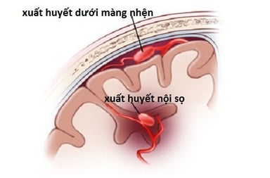 Đối phó với bệnh xuất huyết não không dễ