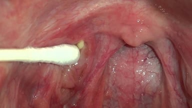 Nguyên nhân gây sỏi amidan là gì?