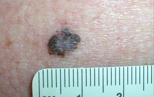 Nốt ruồi ung thư &#8211; cách nhận biết