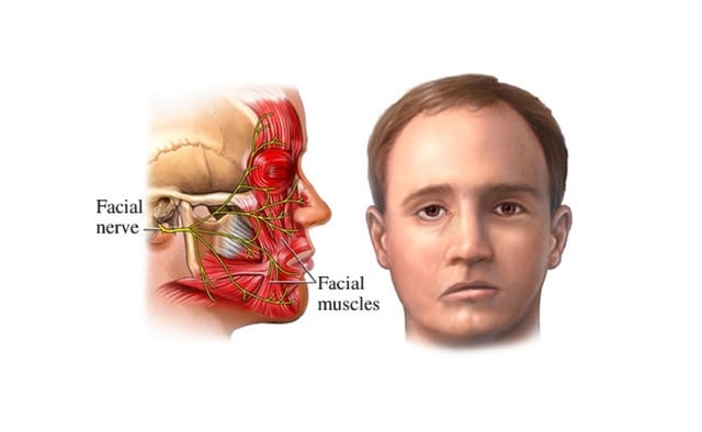 Liệt dây thần kinh số 7 phải làm sao?