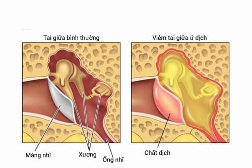 Viêm tai giữa ứ dịch điều trị như thế nào?