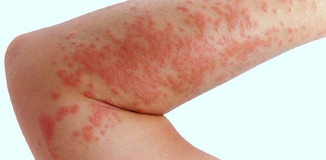 Khám và điều trị bệnh Still ở người lớn