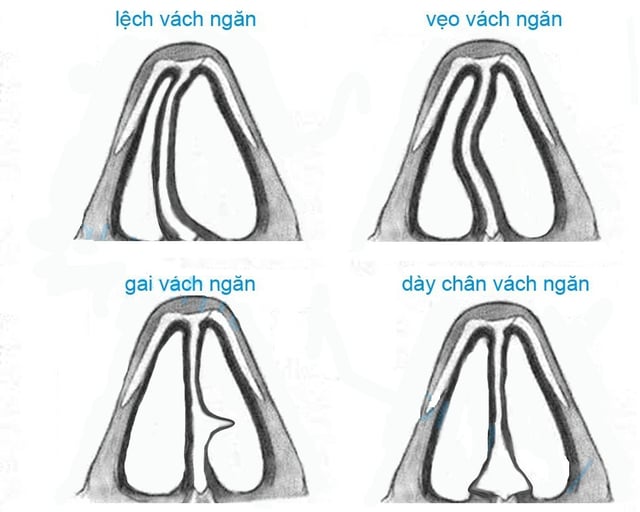 Chỉnh hình vách ngăn mũi được thực hiện như thế nào?