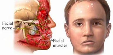 Điều trị bệnh liệt dây thần kinh số 7 ngoại vi
