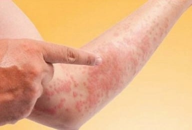 Khám và điều trị bệnh nóng gan